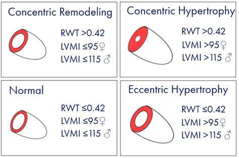 lv mass formula|left ventricular mass index chart.